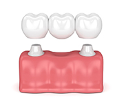 dental-implant-implant-bridges