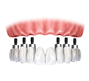 dental-implant-multiple-dental