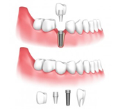 dental-implant-single-tooth