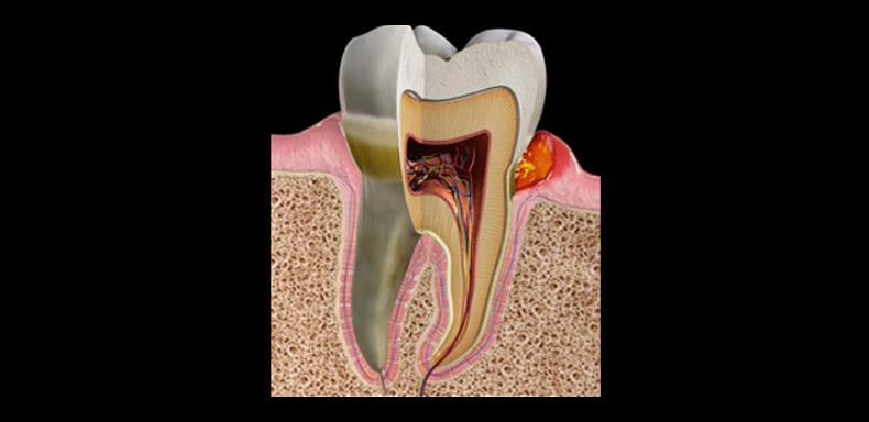 gum-disease