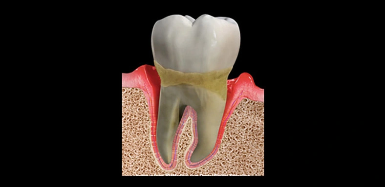 gum-disease