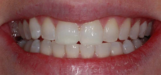 teeth-whitening-img-after