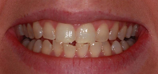 teeth-whitening-img-before