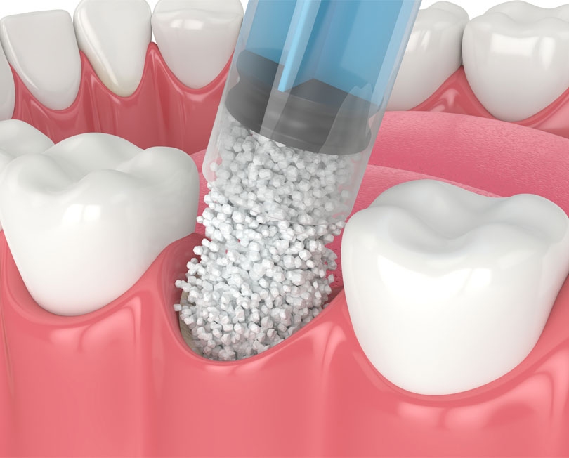 bone-graft-img