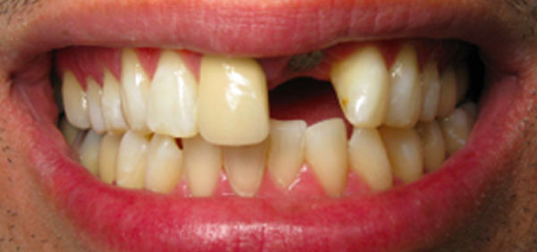 what-is-a-dental-implant-img