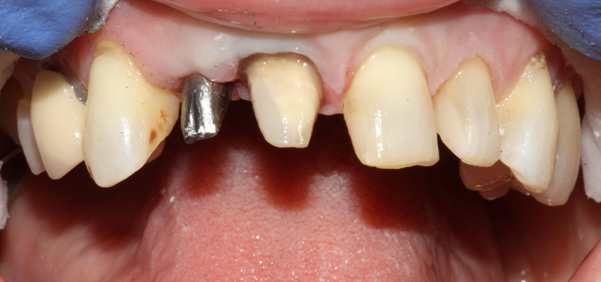 what-is-a-dental-implant-img