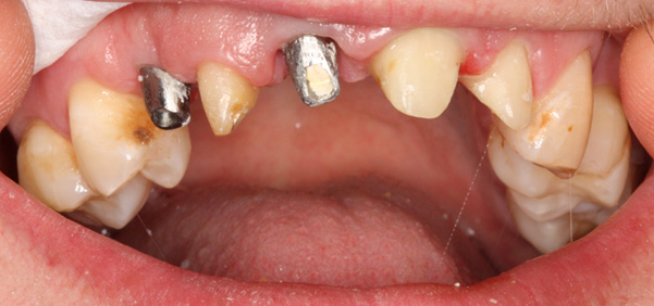 what-is-a-dental-implant-img