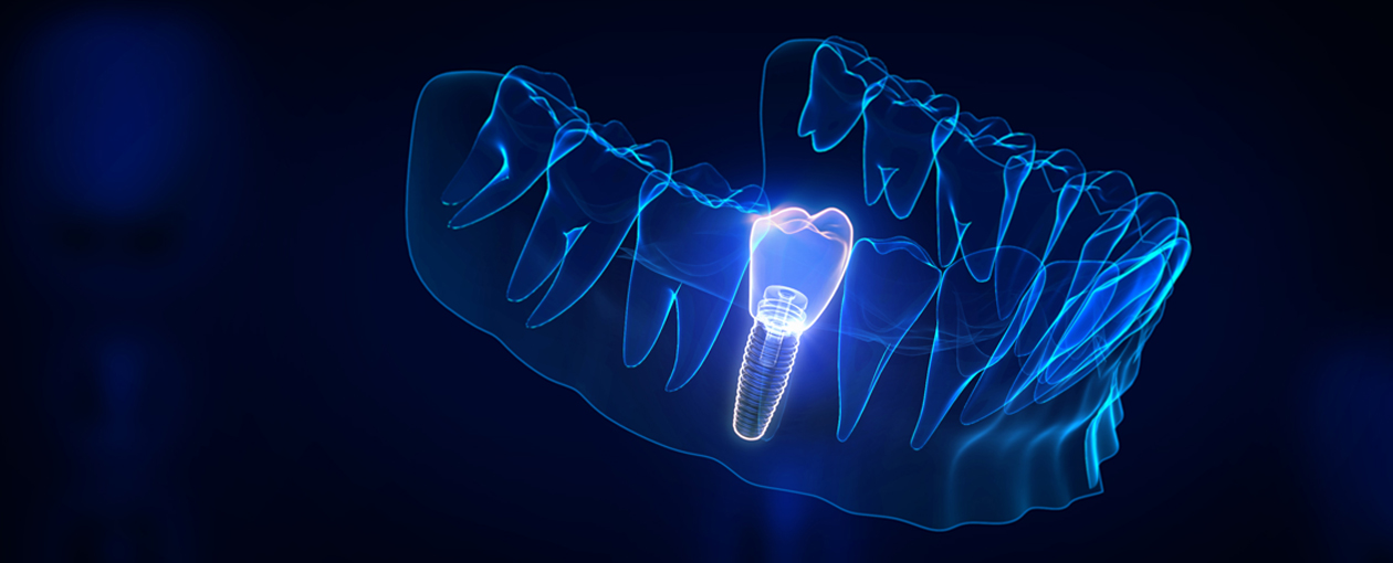 Tooth Replacement: What to Do If You’re Missing Teeth in Ealing & West London