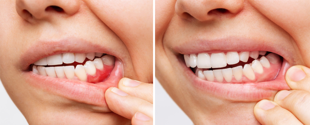 Bleeding Gums? Why You Should Never Ignore Them