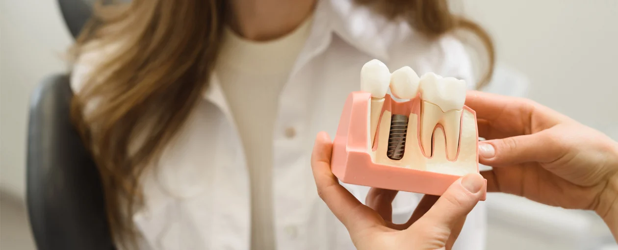 Dental Implants: The Ultimate Patient Guide for 2026